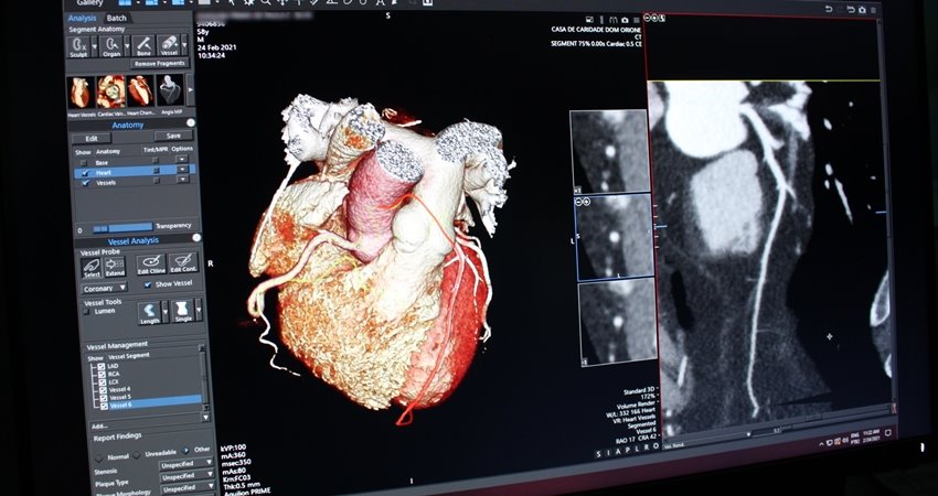 Novo exame possibilita a visualização tridimensional do coração, das suas estruturas e das artérias coronarianas